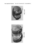 Patient-adapted and improved articular implants, designs and related guide tools diagram and image