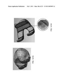 Patient-adapted and improved articular implants, designs and related guide tools diagram and image