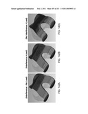 Patient-adapted and improved articular implants, designs and related guide tools diagram and image