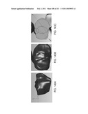 Patient-adapted and improved articular implants, designs and related guide tools diagram and image