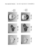 Patient-adapted and improved articular implants, designs and related guide tools diagram and image