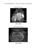 Patient-adapted and improved articular implants, designs and related guide tools diagram and image