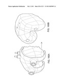 Patient-adapted and improved articular implants, designs and related guide tools diagram and image