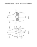 Patient-adapted and improved articular implants, designs and related guide tools diagram and image