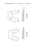 Patient-adapted and improved articular implants, designs and related guide tools diagram and image