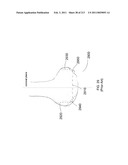 Patient-adapted and improved articular implants, designs and related guide tools diagram and image