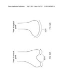 Patient-adapted and improved articular implants, designs and related guide tools diagram and image