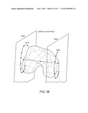 Patient-adapted and improved articular implants, designs and related guide tools diagram and image