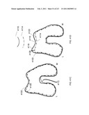 Patient-adapted and improved articular implants, designs and related guide tools diagram and image