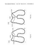 Patient-adapted and improved articular implants, designs and related guide tools diagram and image