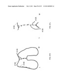 Patient-adapted and improved articular implants, designs and related guide tools diagram and image