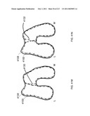 Patient-adapted and improved articular implants, designs and related guide tools diagram and image