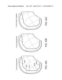 Patient-adapted and improved articular implants, designs and related guide tools diagram and image