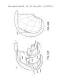 Patient-adapted and improved articular implants, designs and related guide tools diagram and image