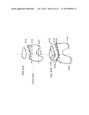 Patient-adapted and improved articular implants, designs and related guide tools diagram and image