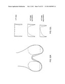 Patient-adapted and improved articular implants, designs and related guide tools diagram and image