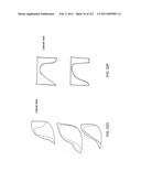 Patient-adapted and improved articular implants, designs and related guide tools diagram and image