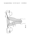 CONTRACEPTIVE TRANSCERVICAL FALLOPIAN TUBE OCCLUSION DEVICES AND METHODS diagram and image