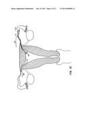 CONTRACEPTIVE TRANSCERVICAL FALLOPIAN TUBE OCCLUSION DEVICES AND METHODS diagram and image