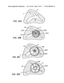 CONTRACEPTIVE TRANSCERVICAL FALLOPIAN TUBE OCCLUSION DEVICES AND METHODS diagram and image