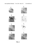 System and Method for Coronary Digital Subtraction Angiography diagram and image