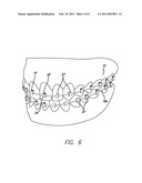 ORTHODONTIC BRACKET SYSTEM AND METHOD diagram and image