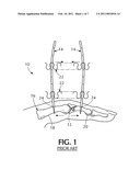 Orthopedic external fixator and method of use diagram and image