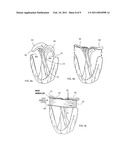 ANNULOPLASTY TUBES diagram and image