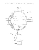 OPHTHALMIC ENDOILLUMINATION WITH THERMALLY ISOLATED PHOSPHOR diagram and image