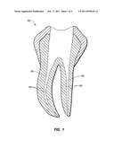 METHOD EMPLOYING ELECTRIC FIELDS TO SELECTIVELY KILL MICROBES IN A ROOT CANAL PREPARATION diagram and image