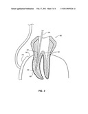 METHOD EMPLOYING ELECTRIC FIELDS TO SELECTIVELY KILL MICROBES IN A ROOT CANAL PREPARATION diagram and image