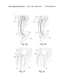 METHOD OF TREATING DENTAL PERIAPICAL LESIONS diagram and image