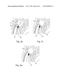 METHOD OF TREATING DENTAL PERIAPICAL LESIONS diagram and image