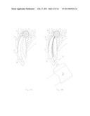 METHOD OF TREATING DENTAL PERIAPICAL LESIONS diagram and image