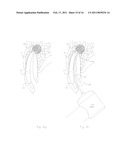 METHOD OF TREATING DENTAL PERIAPICAL LESIONS diagram and image