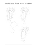 METHOD OF TREATING DENTAL PERIAPICAL LESIONS diagram and image