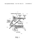 Method and apparatus for weight control by olfactory nerve ablation diagram and image