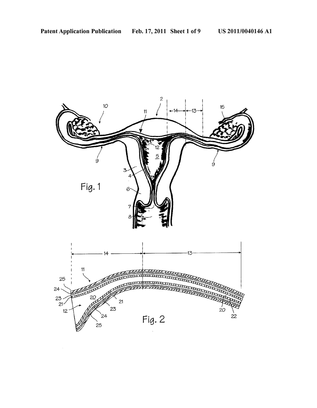 Method and Apparatus for Tubal Occlusion - diagram, schematic, and image 02