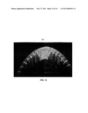 SYSTEM AND METHOD FOR INTRASTROMAL REFRACTIVE CORRECTION diagram and image