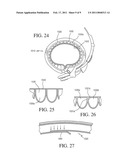 IMPLANTABLE RESTRICTION DEVICE WITH PROTECTIVE MEMBER diagram and image