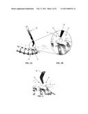 SPINOUS PROCESS SPACER AND IMPLANTATION PROCEDURE diagram and image