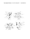 SPINOUS PROCESS SPACER AND IMPLANTATION PROCEDURE diagram and image