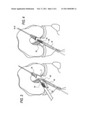 METHOD FOR CREATING A DOUBLE BUNDLE LIGAMENT ORIENTATION IN A SINGLE BONE TUNNEL DURING KNEE LIGAMENT RECONSTRUCTION diagram and image