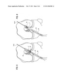 METHOD FOR CREATING A DOUBLE BUNDLE LIGAMENT ORIENTATION IN A SINGLE BONE TUNNEL DURING KNEE LIGAMENT RECONSTRUCTION diagram and image