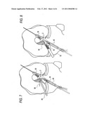 METHOD FOR CREATING A DOUBLE BUNDLE LIGAMENT ORIENTATION IN A SINGLE BONE TUNNEL DURING KNEE LIGAMENT RECONSTRUCTION diagram and image