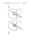 METHOD FOR CREATING A DOUBLE BUNDLE LIGAMENT ORIENTATION IN A SINGLE BONE TUNNEL DURING KNEE LIGAMENT RECONSTRUCTION diagram and image