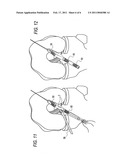 METHOD FOR CREATING A DOUBLE BUNDLE LIGAMENT ORIENTATION IN A SINGLE BONE TUNNEL DURING KNEE LIGAMENT RECONSTRUCTION diagram and image