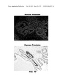 ISOLATED POPULATION OF LUMINAL STEM CELLS THAT GIVE RISE TO PROSTATE CANCER AND METHODS OF USING SAME diagram and image