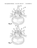 FLOATING SPINAL CANNULA AND METHOD OF USE diagram and image