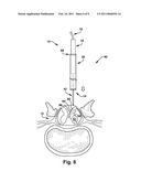 FLOATING SPINAL CANNULA AND METHOD OF USE diagram and image